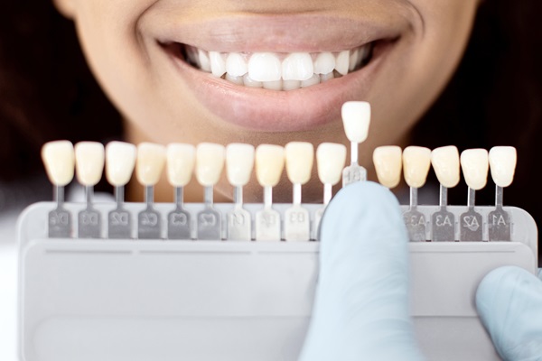 Popular Dental Bonding Solutions